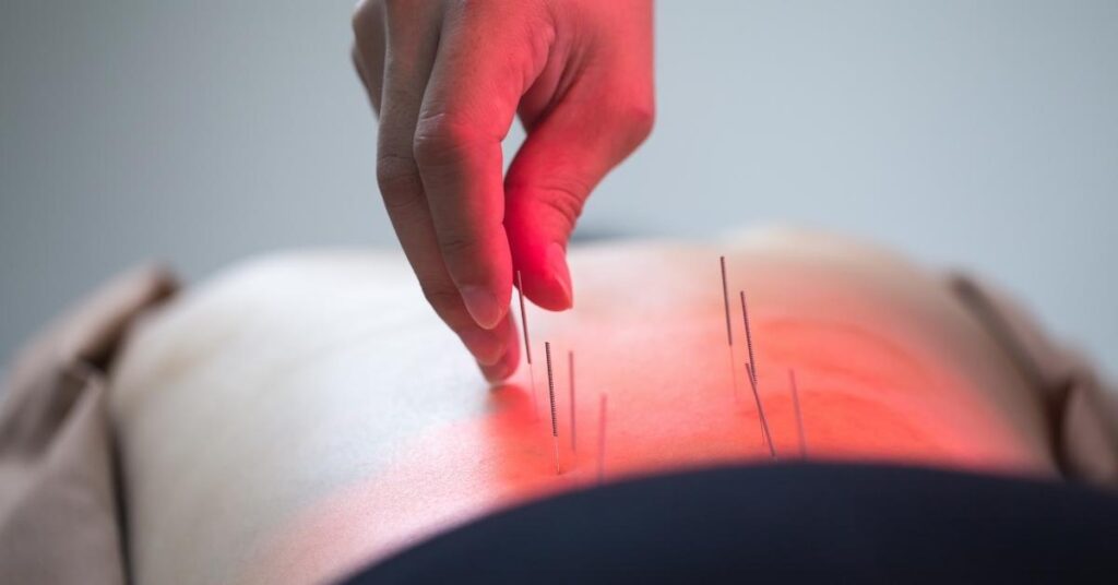 Does acupuncture relieve pain?