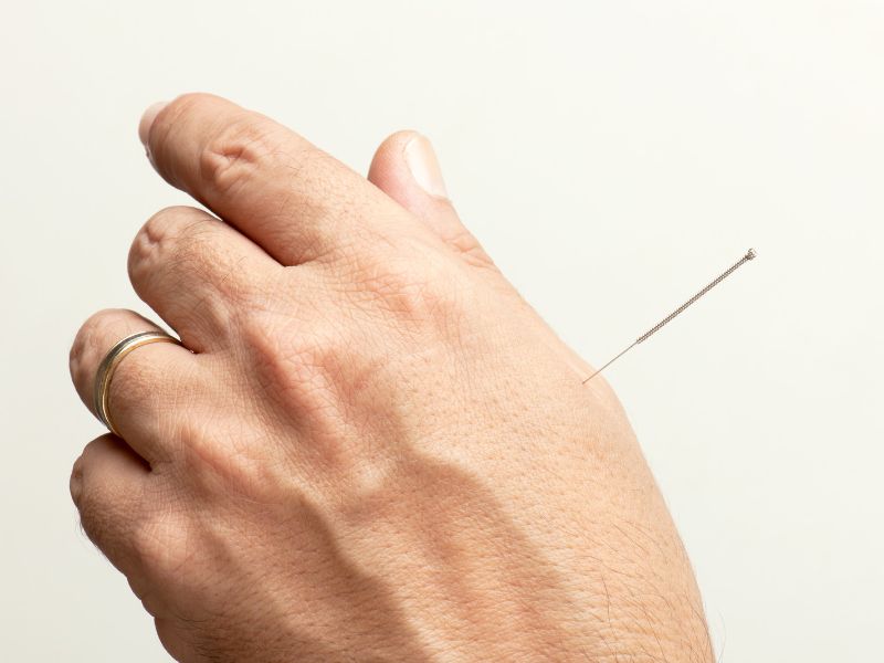 Acupuncture as an alternative treatment for Rheumatoid Arthritis